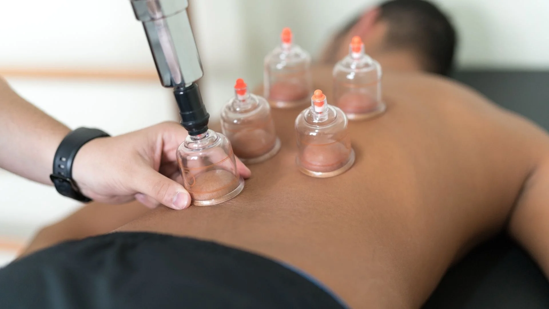 Cupping